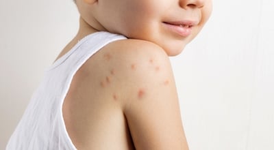 מולוסקום בילדים