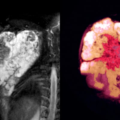 סרקומות של רקמה רכה