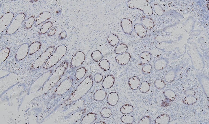 צביעה אימונוהיסטוכימית לסמן השיגשוג MIB-1 המדגים תאים הנמצאים בשלב חלוקה תאית.