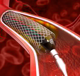 במקום ניתוח לב פתוח, צנתור