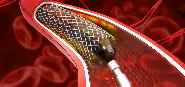 במקום ניתוח לב פתוח, צנתור