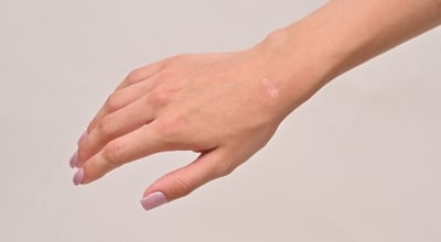 פלסטיקאי יכול להעלים צלקות 