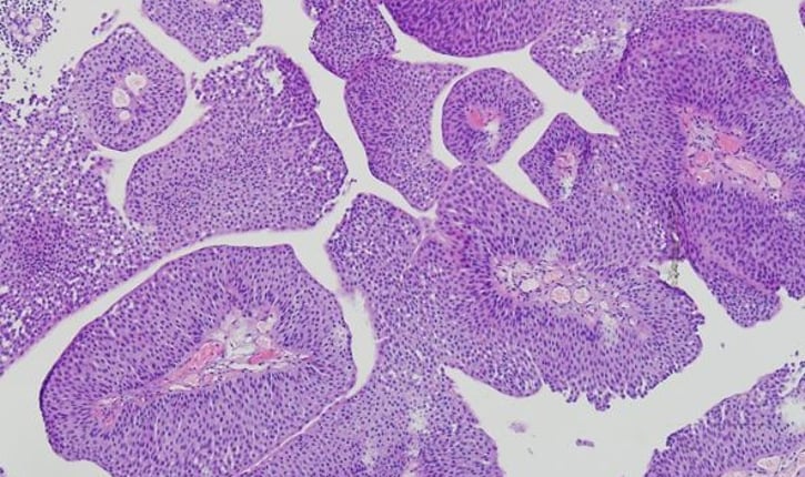 רקמה המתארת גידול פפילרי של כיס השתן נצבעה בצביעת H&E