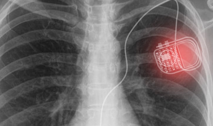 השתלת קוצב לב