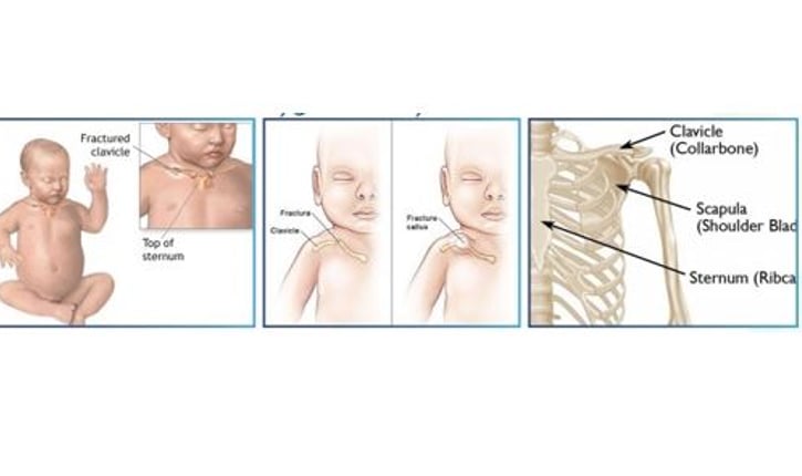 לעיונכם מידע אודות שבר בעצם הבריח אצל תינוקות, אבחון וטיפול
