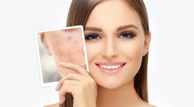 לייזר לטיפול בצלקות