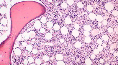 תרומת מח עצם נלקחת מהמוח