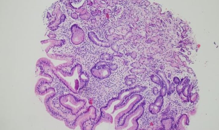רקמה המתארת את רירית הקיבה עם דלקת כרונית נצבעה בצביעת H&E