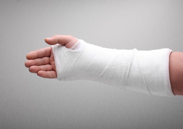 איך מגבסים יד שבורה