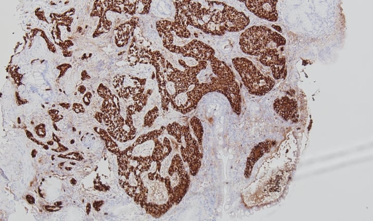 צביעה אימונוהיסטוכימית לכרומוגרנין- הצביעה מדגימה גידול נויראואנדוקריני.