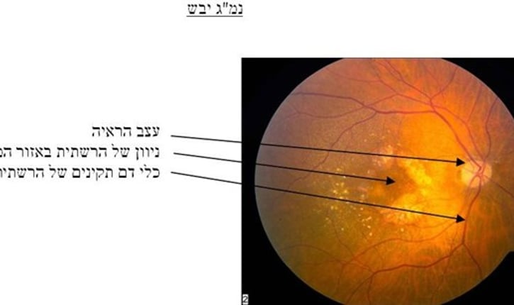 נמ''ג יבש: עצב הראיה, ניוון של הרשתית באזור המקולה, כלי דם תקינים של הרשתית