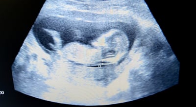 שקיפות עורפית