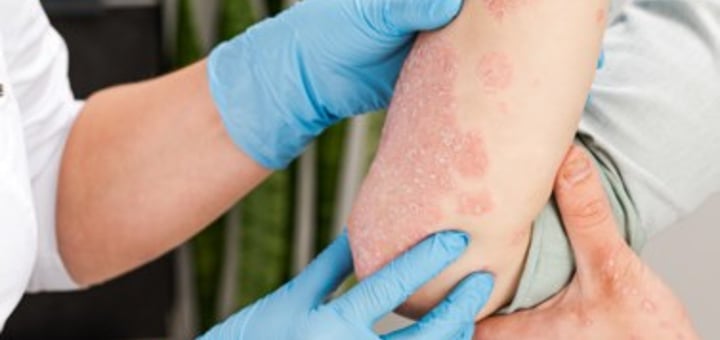 מהי אסתמה של העור 