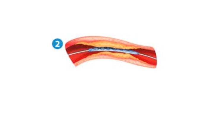 כדי לטפל בבעיה, מבצעים צנתור התערבותי: הרופא מחדיר צנתר, שהוא צינור דק, חלול וגמיש שבקצהו בלון. 