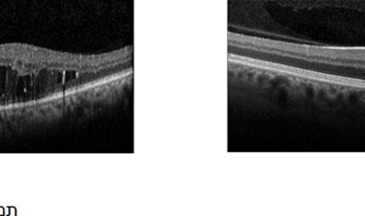 צילום OCT של רשתית תקינה (2א) ושל רשתית עם בצקת מקולרית (2ב).