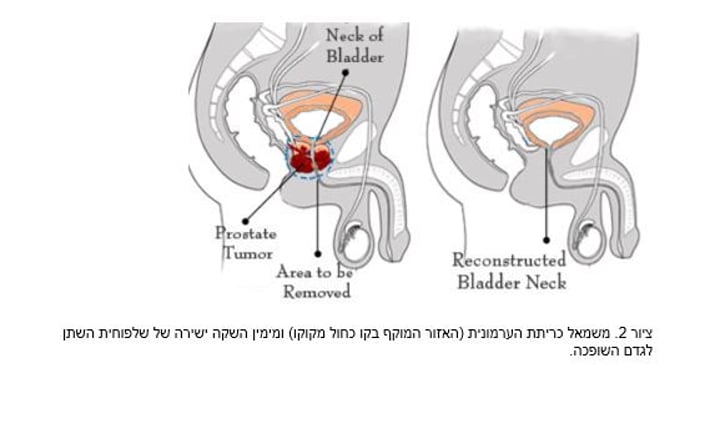 ציור 2. משמאל כריתת הערמונית (האזור המוקף בקו כחול מקוקו) ומימין השקה ישירה של שלפוחית השתן לגדם השופכה.