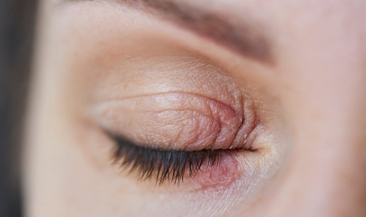 בלפריטיס (דלקת עפעפיים)