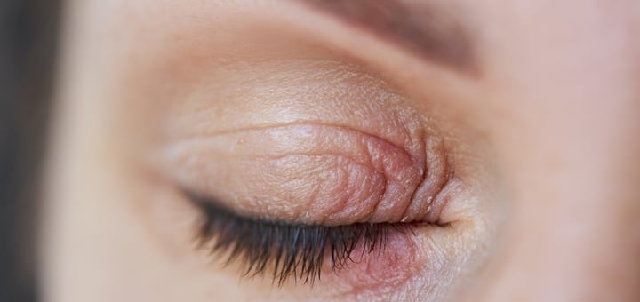 בלפריטיס (דלקת עפעפיים)