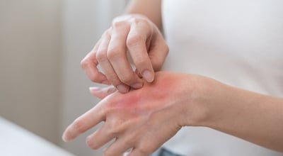 אוטופיק דרמטיטיס