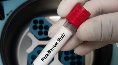 תרומת מח עצם פוגעת בפוריות