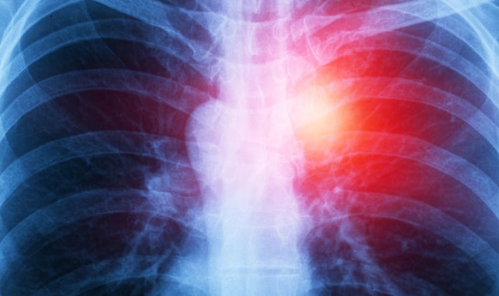 מזותליומה פליאורלית