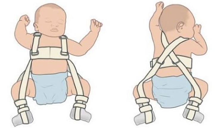 תיקון של דיספלזיה של מפרק הירך בתינוקות