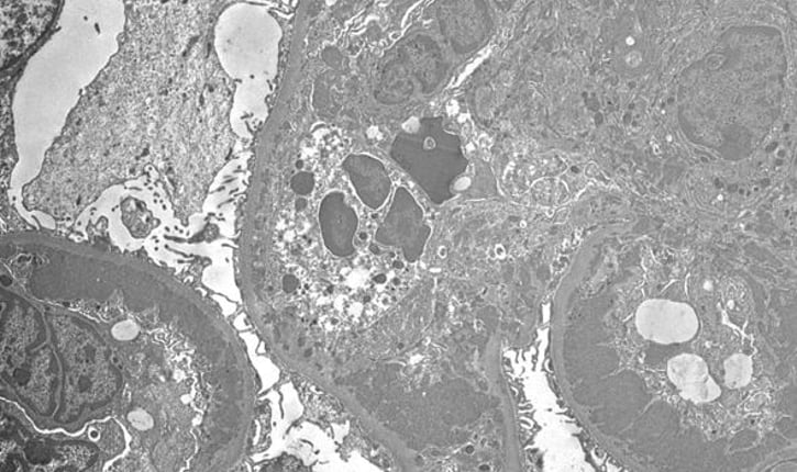 ניתן לראות בתמונה המצורפת רקמה עם משקעים תת אנדותליאליים ענקיים, האופייניים למחלת לופוס פעילה שאובחנה על ידי מיקרוסקופ אלקטרונים.