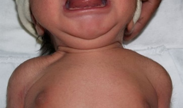 הסימפטומים לשבר בעצם הבריח אצל תינוקות