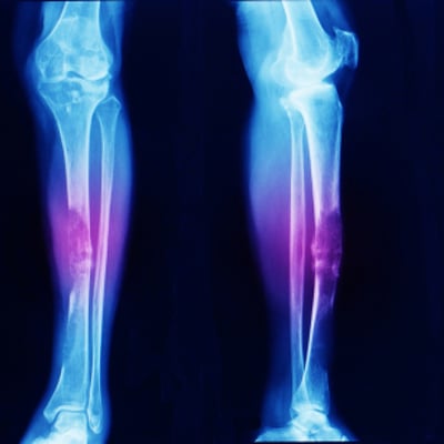 אורתופודיה אונקולוגית