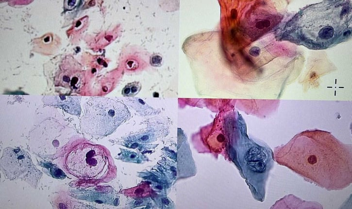 להלן תמונה המציגה תאי אפיתל (koilocytes) שהודבקו בוירוס הפפילומה (HPV). ניתן להבחין בהגדלה גרעינית ובשינוים נוספים המתרחשים במבנה המורפולוגי של התא.