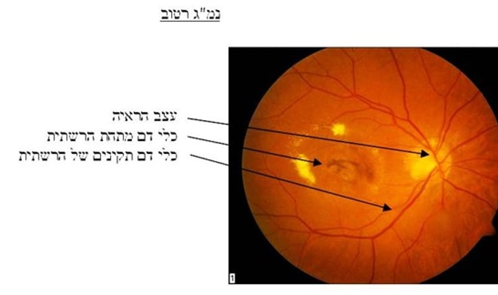 נמ''ג רטוב: עצב הראיה, כלי דם מתחת הרשתית, כלי דם תקינים של הרשתית