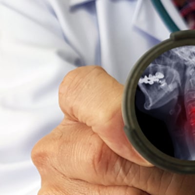 מהם גידולים ממאירים של העצם