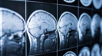 מוות מוחי הוא מוות לכל דבר