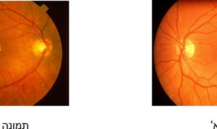 תצלום של קרקעית עין ימין של חולה עם רטינופתיה סוכרתית. באזור המקולה (מרכז הצילום), ניתן לראות הצטברות של שומנים ודימומים ובצקת מקולרית (חץ).