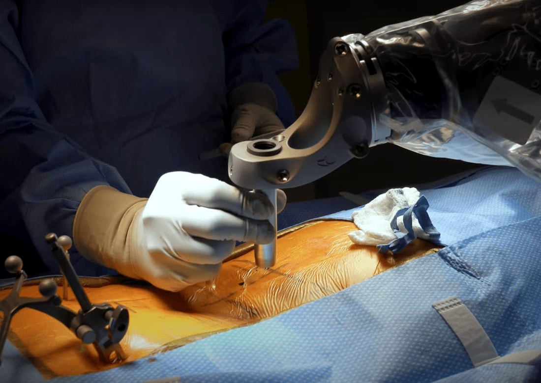Globus robotic navigation for complex spine deformity surgery
