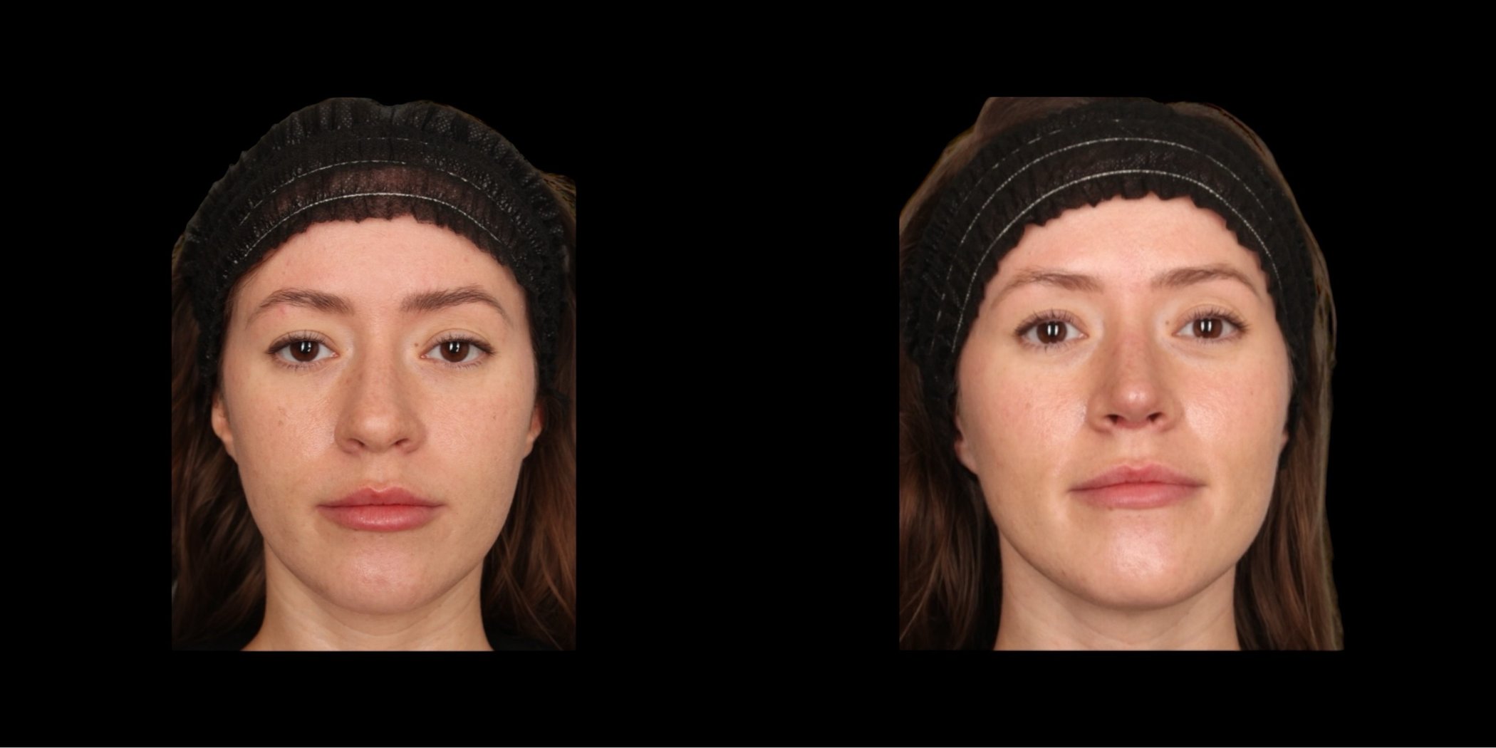 Rhinoplasty before-and-after composite, Consona Plastic Surgery – case 1, view 2