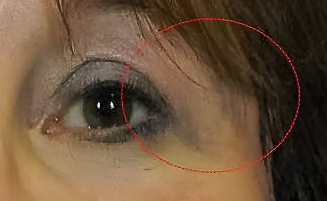 Eyelid Surgery after surgery – Murrieta Facial Plastic Surgery, case 7