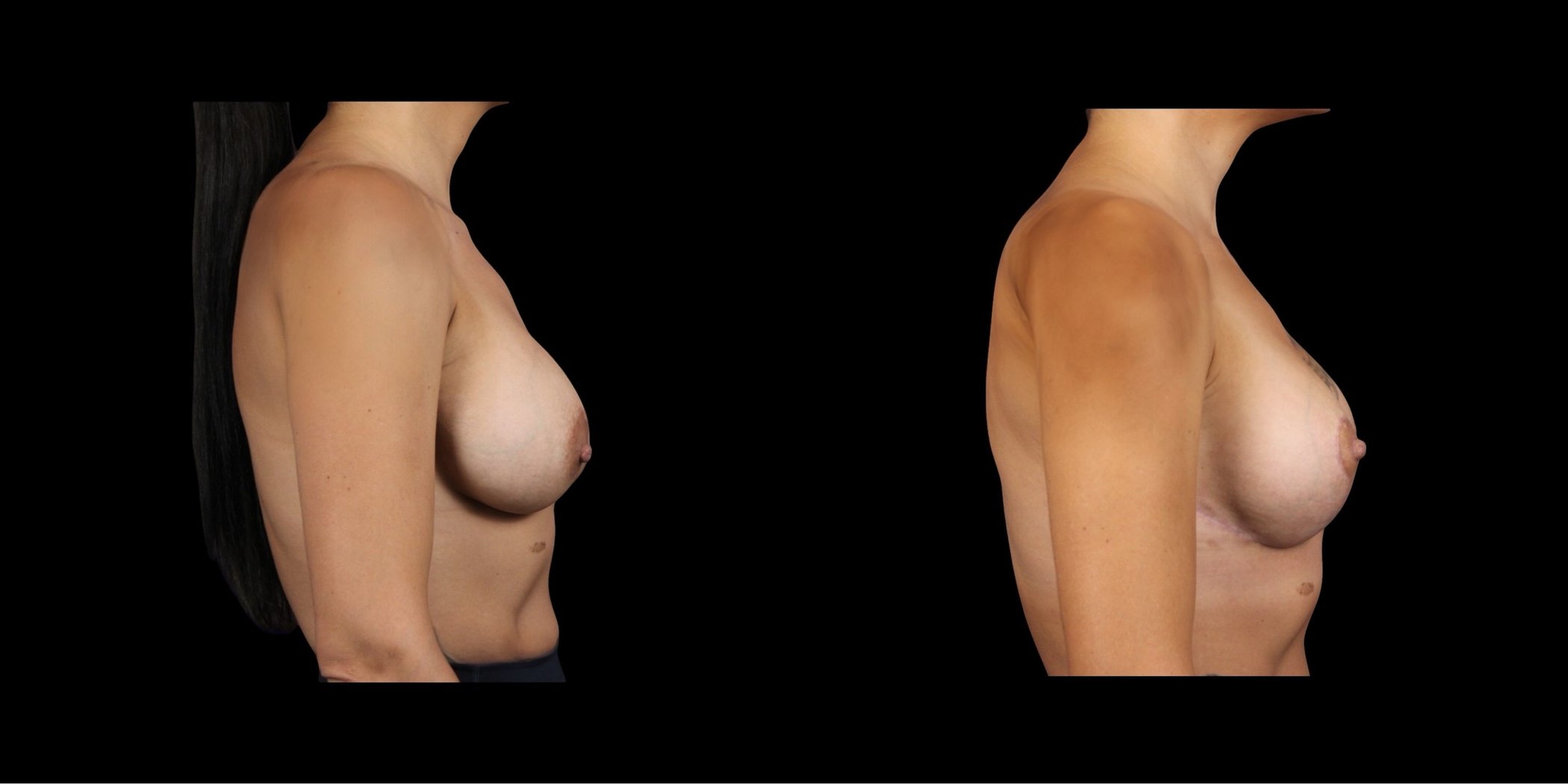 Augmentation Mastopexy before-and-after composite, Consona Plastic Surgery – case 1, view 3