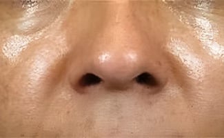 Facial Fat Grafting before surgery – Murrieta Facial Plastic Surgery, case 1