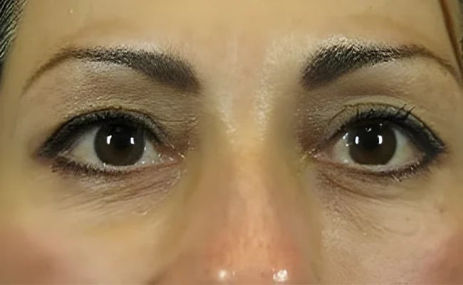Eyelid Surgery before surgery – Murrieta Facial Plastic Surgery, case 15