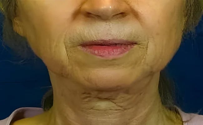 Facelift before surgery – Murrieta Facial Plastic Surgery, case 26