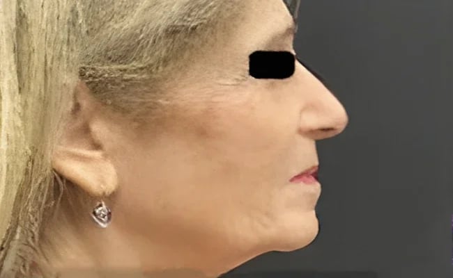 Facelift before surgery – Murrieta Facial Plastic Surgery, case 6