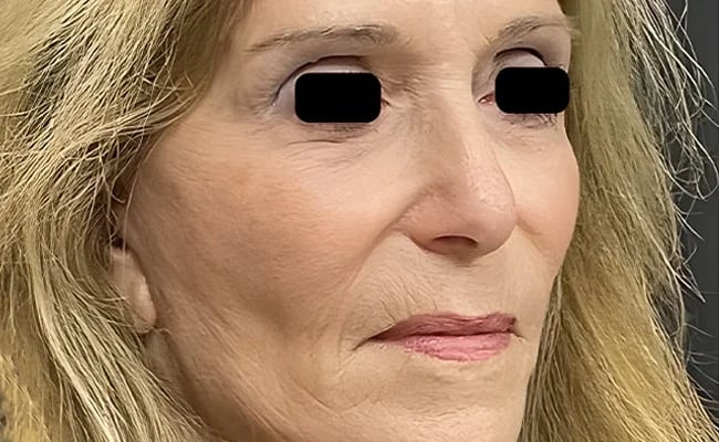 Brow Lift after surgery – Murrieta Facial Plastic Surgery, case 7