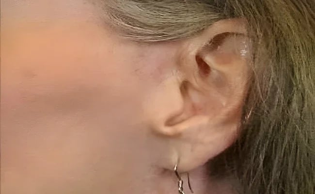 Facelift after surgery – Murrieta Facial Plastic Surgery, case 16