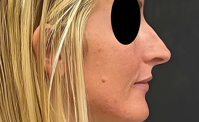 Rhinoplasty before surgery – Murrieta Facial Plastic Surgery, case 14