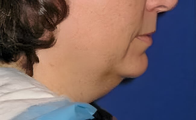 Neck Lift before surgery – Murrieta Facial Plastic Surgery, case 6