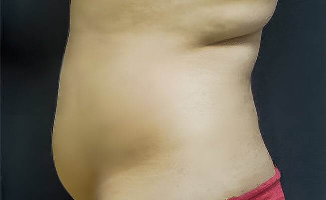Liposuction before surgery – Murrieta Facial Plastic Surgery, case 7