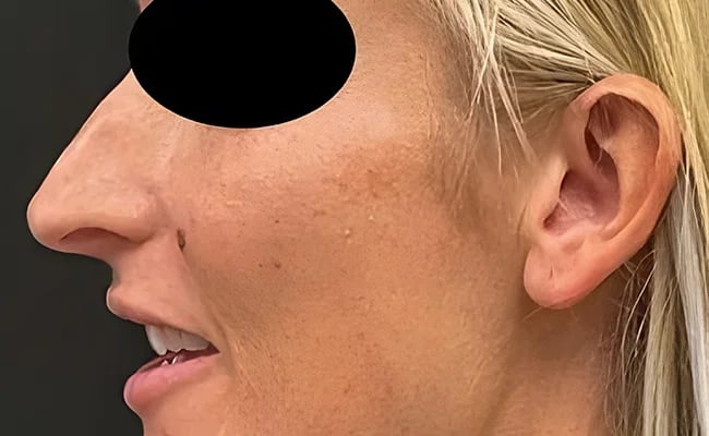 Rhinoplasty before surgery – Murrieta Facial Plastic Surgery, case 13