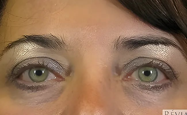 Eyelid Surgery after surgery – Murrieta Facial Plastic Surgery, case 14