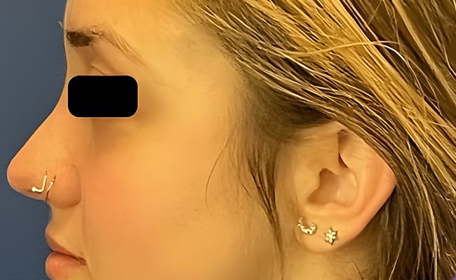 Rhinoplasty before surgery – Murrieta Facial Plastic Surgery, case 9